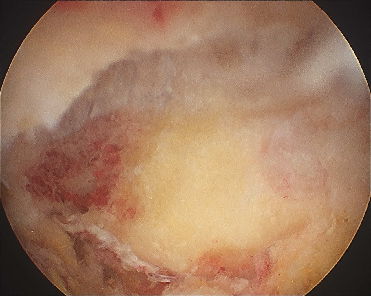 Post Arthroscopic ACJ resection